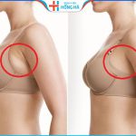 Hút mỡ nách an toàn không: 6 tiêu chí đảm bảo hút mỡ an toàn