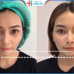 Độn cằm bằng sụn tự thân có duy trì vĩnh viễn không? Chi phí bao nhiêu?