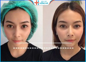 Độn cằm bằng sụn tự thân có duy trì vĩnh viễn không? Chi phí bao nhiêu?