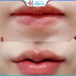 Tạo hình môi trái tim ở đâu đẹp : Thẩm mỹ  Hồng Hà tạo hình môi đẹp, uy tín
