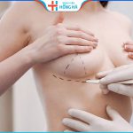 Nâng ngực có để lại sẹo không? 3 cách phòng ngừa sẹo siêu hiệu quả