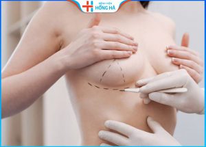 Nâng ngực có để lại sẹo không? 3 cách phòng ngừa sẹo siêu hiệu quả