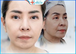 Căng chỉ da mặt được bao lâu? Cách chăm sóc da kéo dài tuổi xuân
