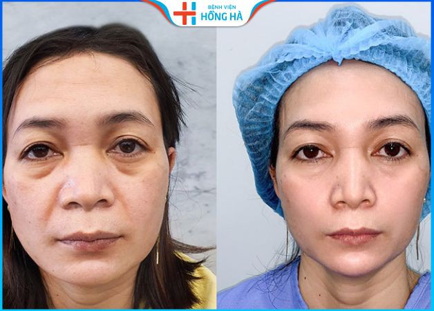 Căng da mặt bằng chỉ giá bao nhiêu? 3 Yếu tố ảnh hưởng đến chi phí