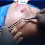Cắt  mí có để lại sẹo không – 3 yếu tố gây sẹo xấu khi cắt mí