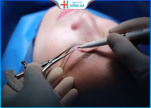 Cắt  mí có để lại sẹo không – 3 yếu tố gây sẹo xấu khi cắt mí