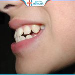 Chỉnh hàm răng hô thực hiện một lần duy nhất hiệu quả lâu dài