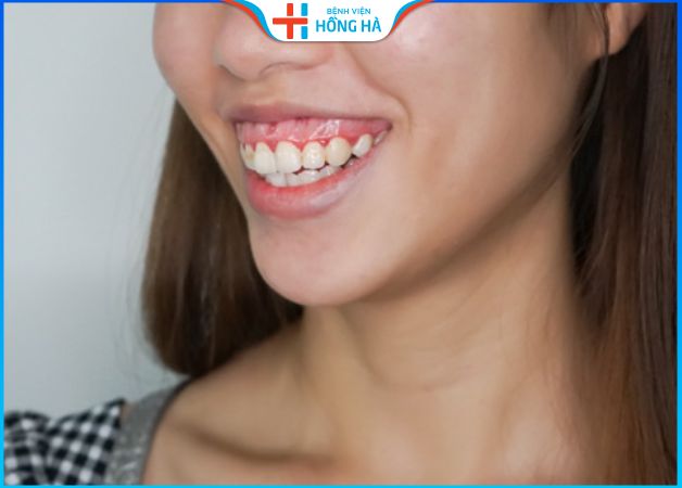 Cười hở lợi tướng số nữ sướng hay khổ – 4 cách điều trị hiệu quả