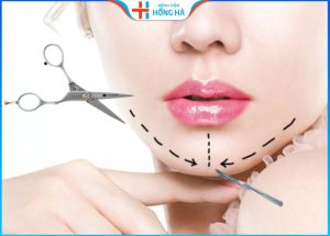 Giải đáp: Độn cằm mấy ngày hết sưng? Chăm sóc sau độn cằm?