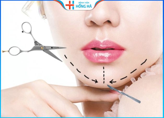 Giải đáp: Độn cằm mấy ngày hết sưng? Chăm sóc sau độn cằm?