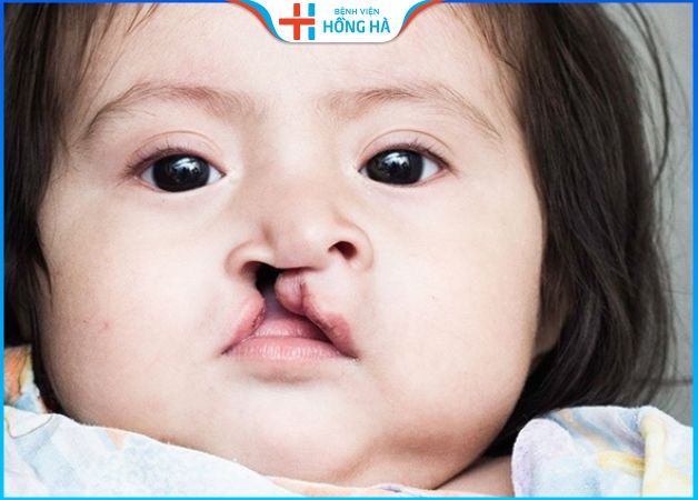 Hở hàm ếch có di truyền không? Phương pháp điều trị hở hàm ếch ở trẻ