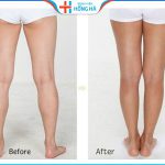 Hút mỡ bắp chân ở đâu tốt: 4 tiêu chí lựa chọn địa chỉ hút mỡ an toàn