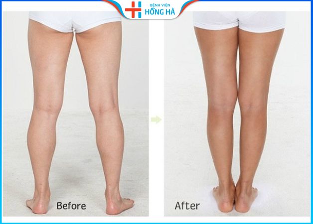 Hút mỡ bắp chân ở đâu tốt: 4 tiêu chí lựa chọn địa chỉ hút mỡ an toàn
