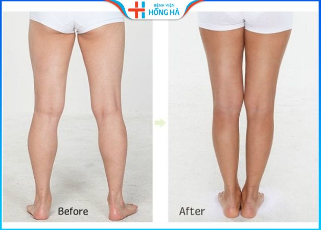 Hình ảnh trước và sau khi hút mỡ bắp chân
