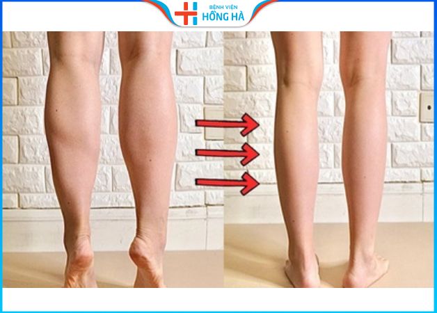 Hình ảnh trước và sau khi hút mỡ bắp chân