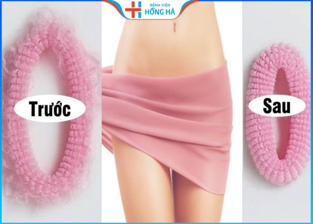 Thẩm mỹ vùng kín sau 3-5 ngày thì lành và 1,5 - 2 tháng đẹp tự nhiên