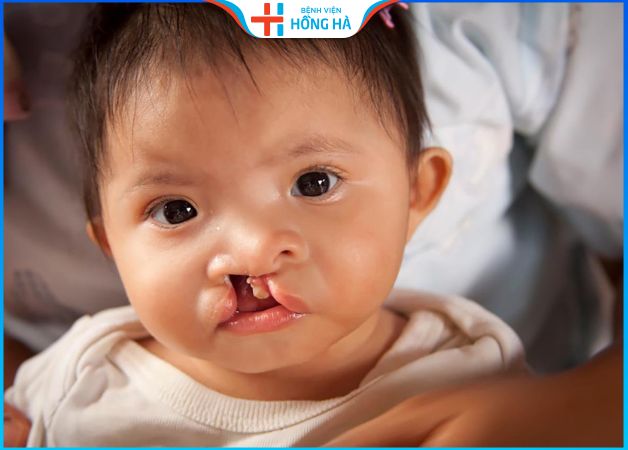Trẻ bị môi hở hàm ếch khi nào cần phẫu thuật – Cách dự phòng dị tật