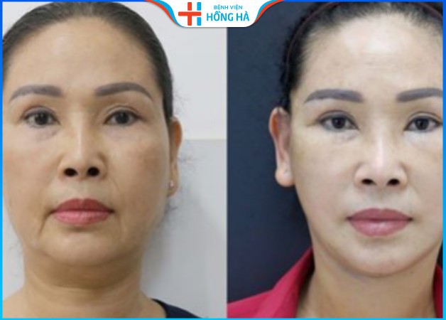 Chị Thu Mai bất ngờ về kết quả căng da mặt tại Hồng Hà