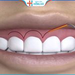Phẫu thuật cười hở lợi bao lâu thì lành? 4 Lưu ý quan trọng cần biết