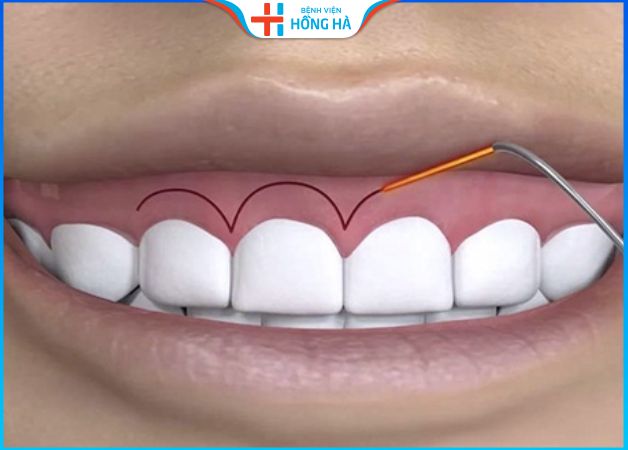 Phẫu thuật cười hở lợi bao lâu thì lành? 4 Lưu ý quan trọng cần biết