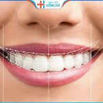 Phẫu thuật cười hở lợi có nguy hiểm không – 3 Lưu ý sau điều trị