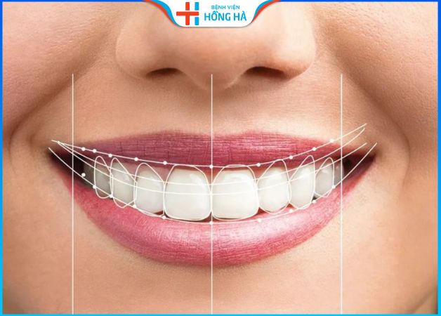 Phẫu thuật cười hở lợi có nguy hiểm không – 3 Lưu ý sau điều trị