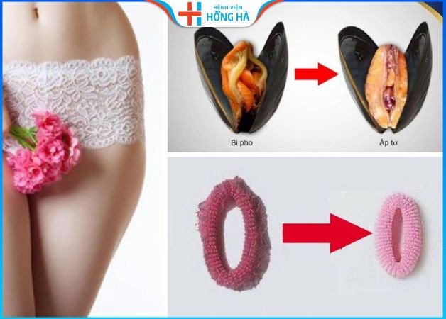 Quá trình lành thương sau thẩm mỹ vùng kín