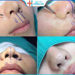 Thu nhỏ cánh mũi có ảnh hưởng gì không? Chuyên gia giải đáp