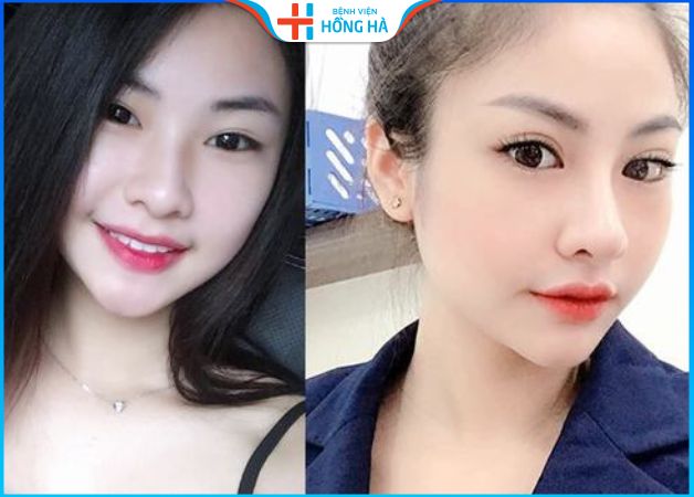 Khách hàng tự tin sở hữu chiếc mũi nhỏ, cao đẹp