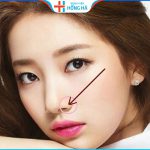 Thu nhỏ cánh mũi ở đâu đẹp – 4 yếu tố lựa chọn địa chỉ tốt, uy tín
