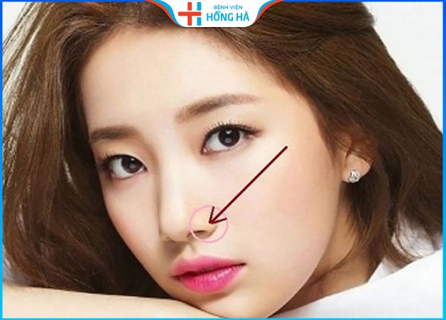 Thu nhỏ cánh mũi ở đâu đẹp – 4 yếu tố lựa chọn địa chỉ tốt, uy tín