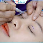 Bấm mí mắt có bị sưng không – Cách chăm sóc sau cắt mí mắt