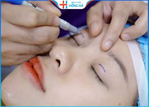 Bấm mí mắt có bị sưng không – Cách chăm sóc sau cắt mí mắt