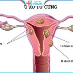U xơ tử cung: Các triệu chứng và cách chữa trị hiệu quả