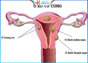 U xơ tử cung: Các triệu chứng và cách chữa trị hiệu quả