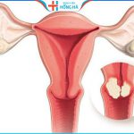 3 phương pháp điều trị u xơ tử cung hiệu quả, bảo toàn thiên chức làm mẹ