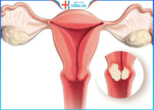 Những lợi ích tuyệt vời của uống nước dứa chữa u xơ tử cung 