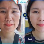 Căng da mặt bằng chỉ có đau không – 10 Cách chăm sóc không đau