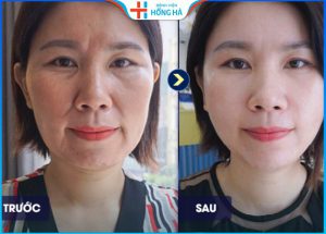 Căng da mặt bằng chỉ có đau không – 10 Cách chăm sóc không đau