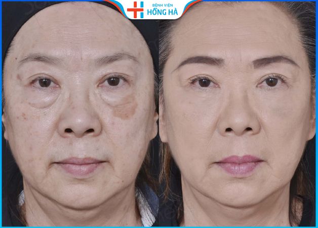 Chị Phương Nguyễn chia sẻ cảm nhận căng da mặt tại BV Hồng Hà