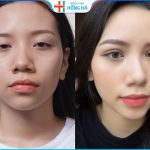 Thu nhỏ cánh mũi có nguy hiểm không – Lưu ý hạn chế ảnh hưởng sức khỏe