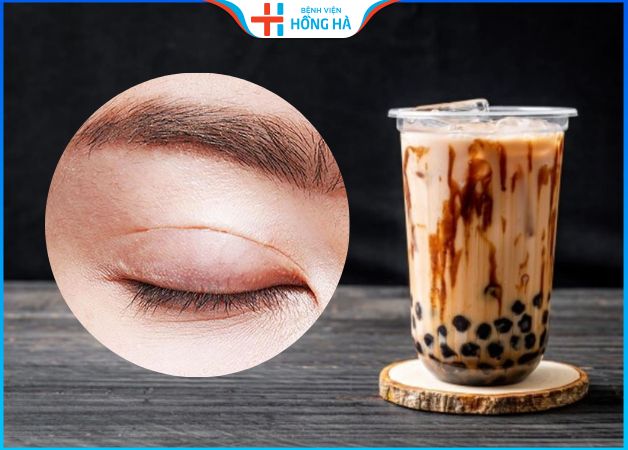 Cắt mí có được uống trà sữa không – 3 Lưu ý uống trà sữa sau cắt mí