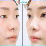 Cắt mí có nguy hiểm không – 5 lưu ý đảm bảo an toàn sau cắt mí