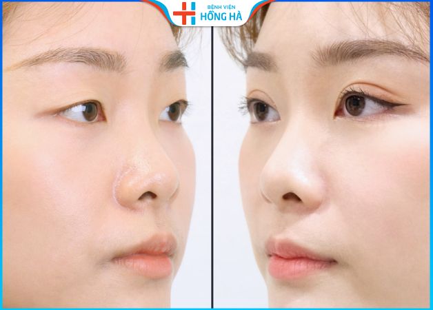 Cắt mí có nguy hiểm không – 5 lưu ý đảm bảo an toàn sau cắt mí