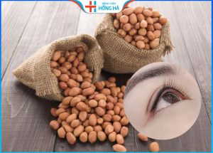 Cắt mí mắt có ăn đậu phộng được không –  4 Giai đoạn hồi phục