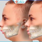 Chỉnh hô hàm trên phương pháp nào hiệu quả nhất? Sau bao lâu thì đẹp