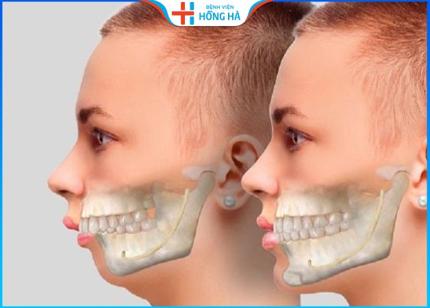 Chỉnh hô hàm trên phương pháp nào hiệu quả nhất? Sau bao lâu thì đẹp