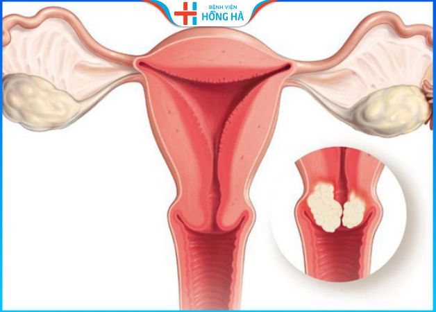 80% phụ nữ mắc u xơ tử cung: 7 Nhận biết các dấu hiệu và triệu chứng