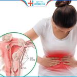 U xơ tử cung: Nguy cơ biến chứng và ảnh hưởng đến sức khỏe phụ nữ