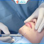Độn cằm có dễ bị lệch không – 3 điều cần tránh sau khi độn cằm lệch